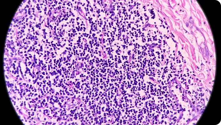 hidradenitis supurativa internacional (HSI4)