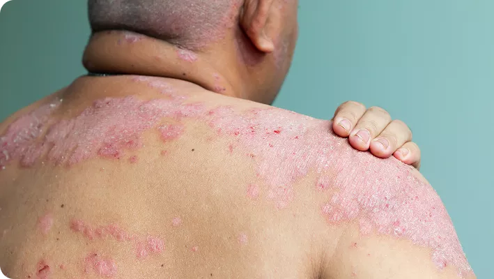 PsoriasisLessionBack