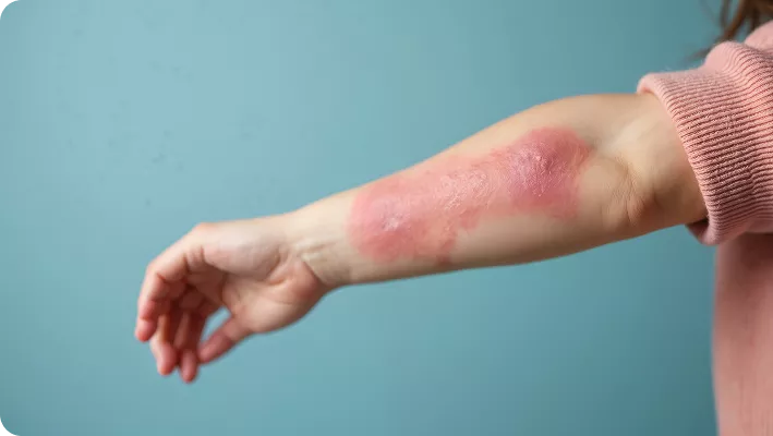 PsoriasisLessionForearm2