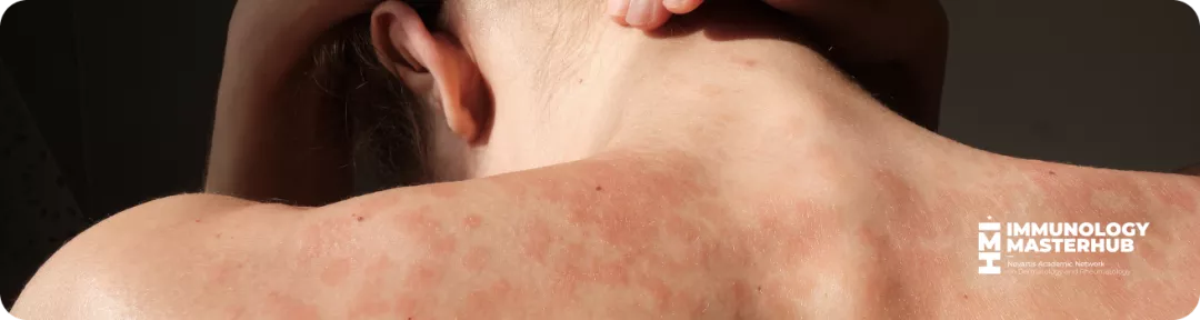 Banner1Psoriasis2025