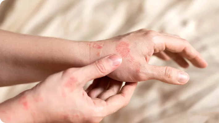 PsoriasisLessionHands