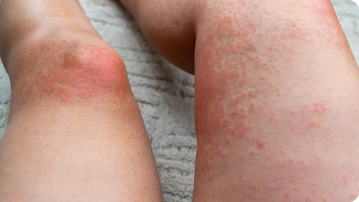 Hidradenitis Lession Legs