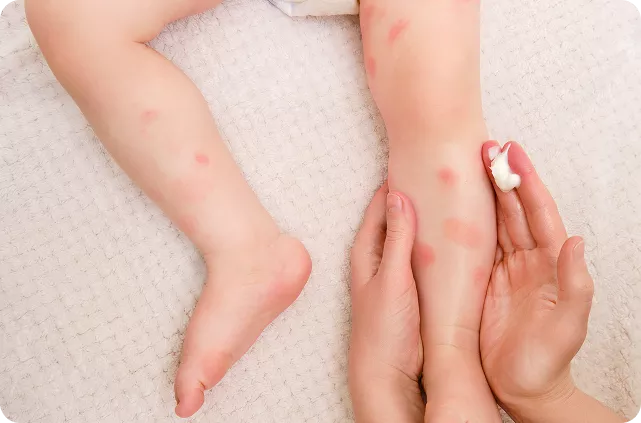 PsoriasisLessionLegsBaby