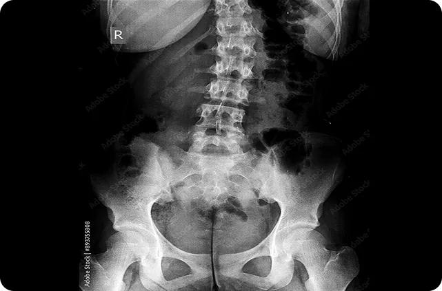 EspondiloartritisLessionHip