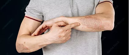 Artritis Psoriásica (APs)