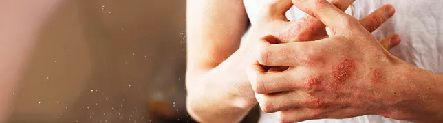 image_card_psoriasis