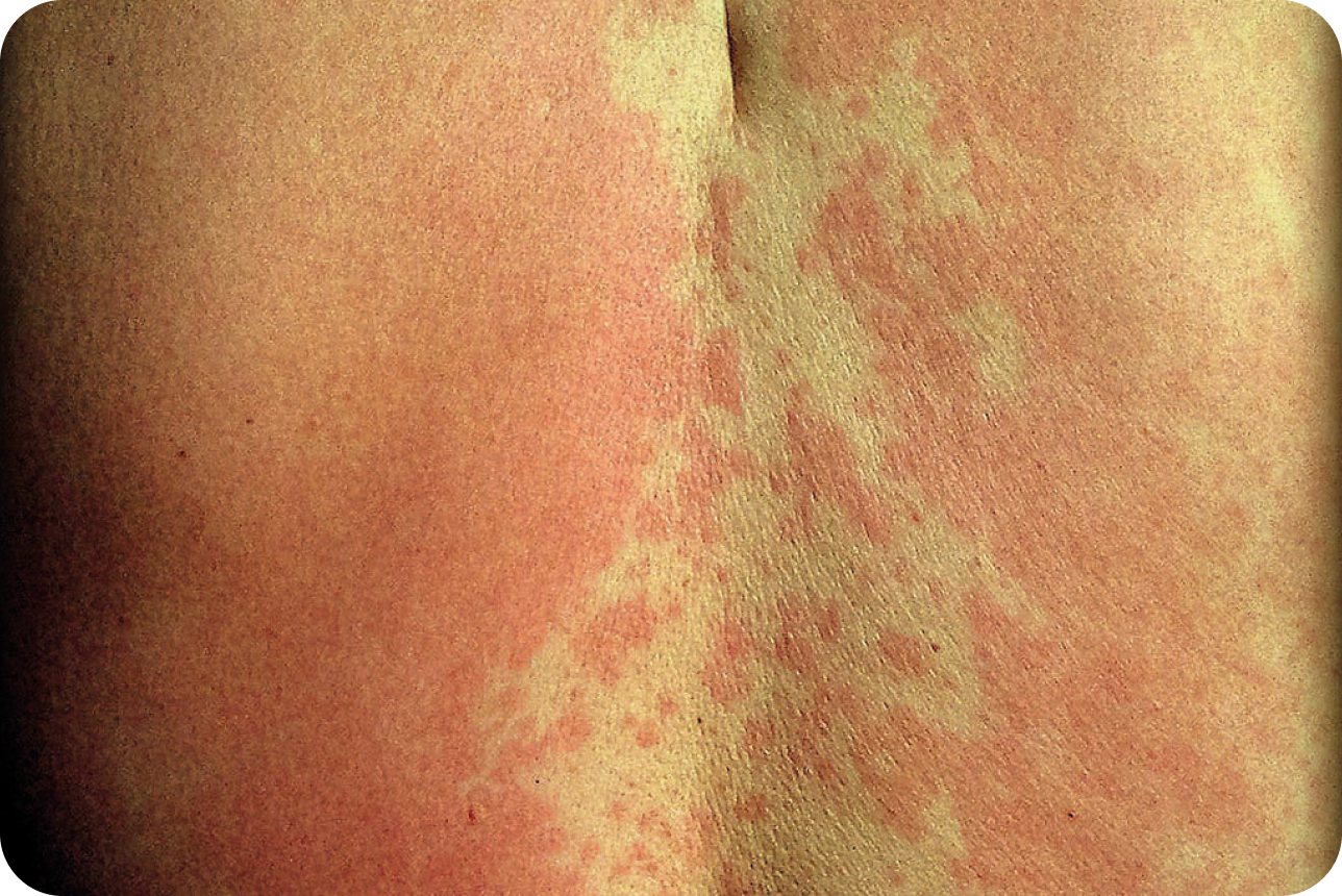 urticaria1-img1 urticaria1-img1