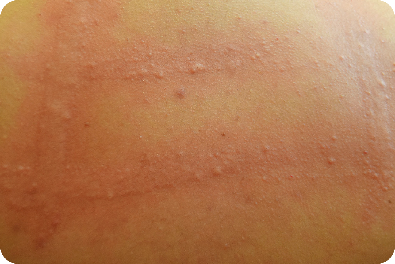 urticaria1-img2 urticaria1-img2