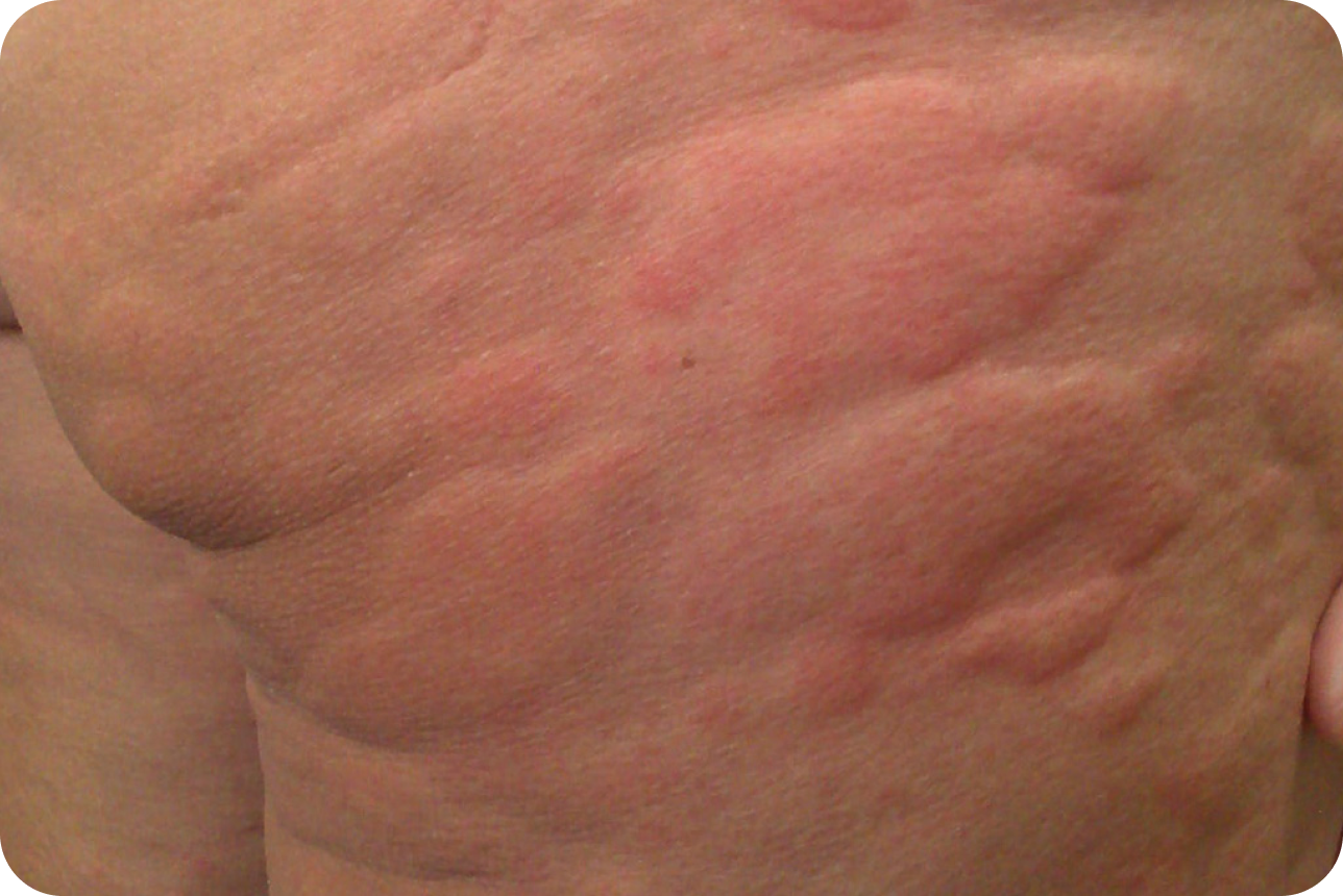 urticaria1-img3 urticaria1-img3