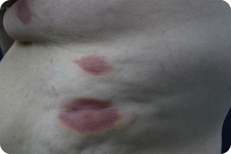 urticaria10-1_1 urticaria10-1_1