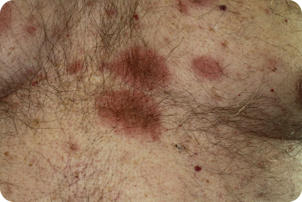 urticaria10-1_2 urticaria10-1_2
