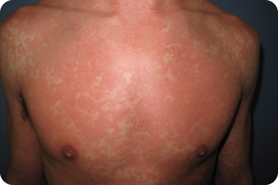 urticaria10_1 urticaria10_1