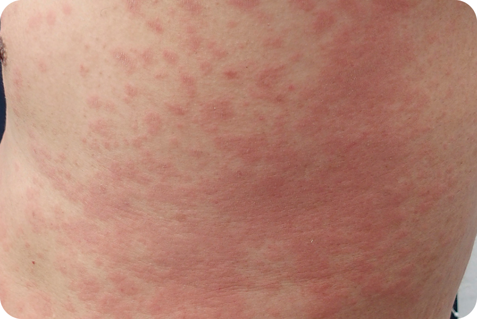 urticaria10_3 urticaria10_3