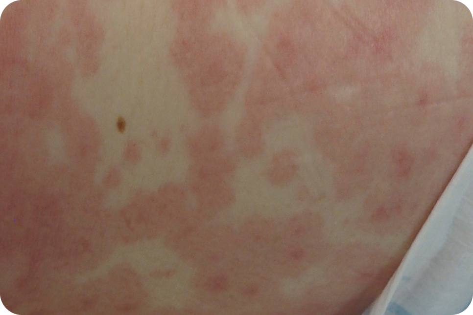 urticaria10_4 urticaria10_4