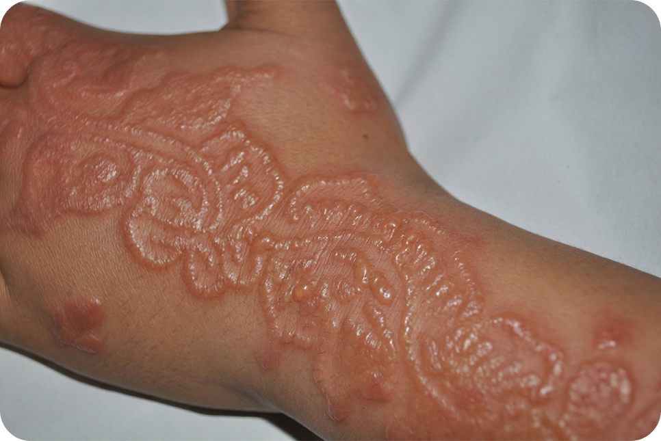 urticaria14_1 urticaria14_1
