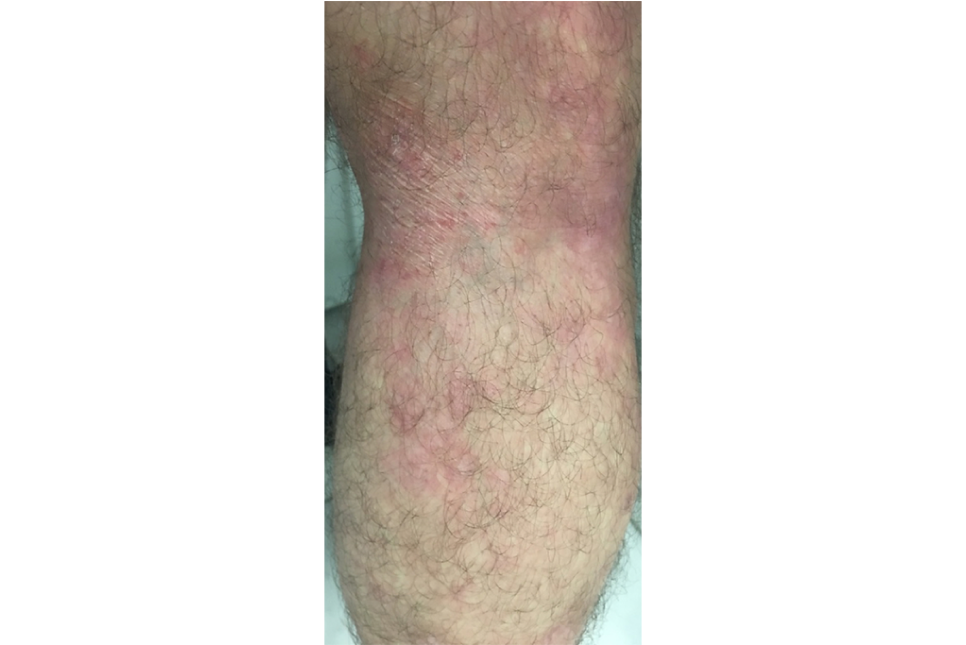 urticaria16_1 urticaria16_1