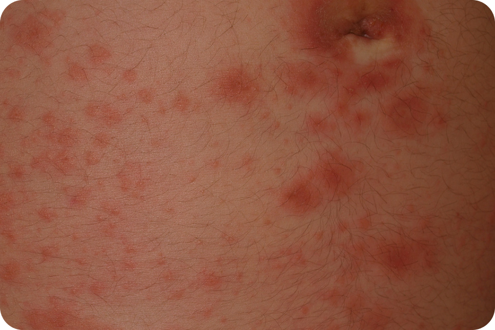 urticaria19_1 urticaria19_1