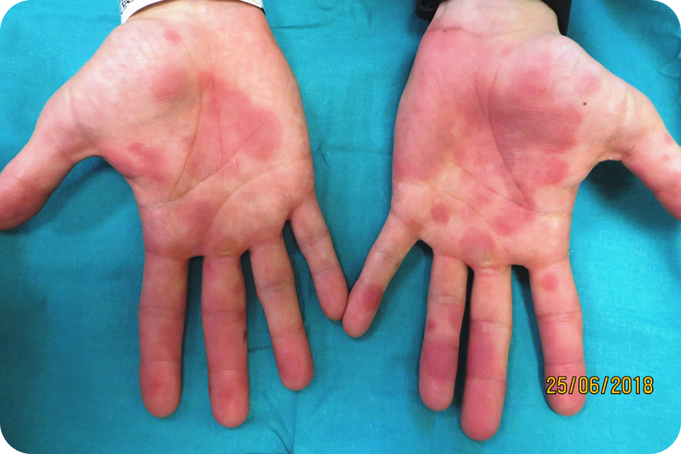urticaria2-2_1 urticaria2-2_1