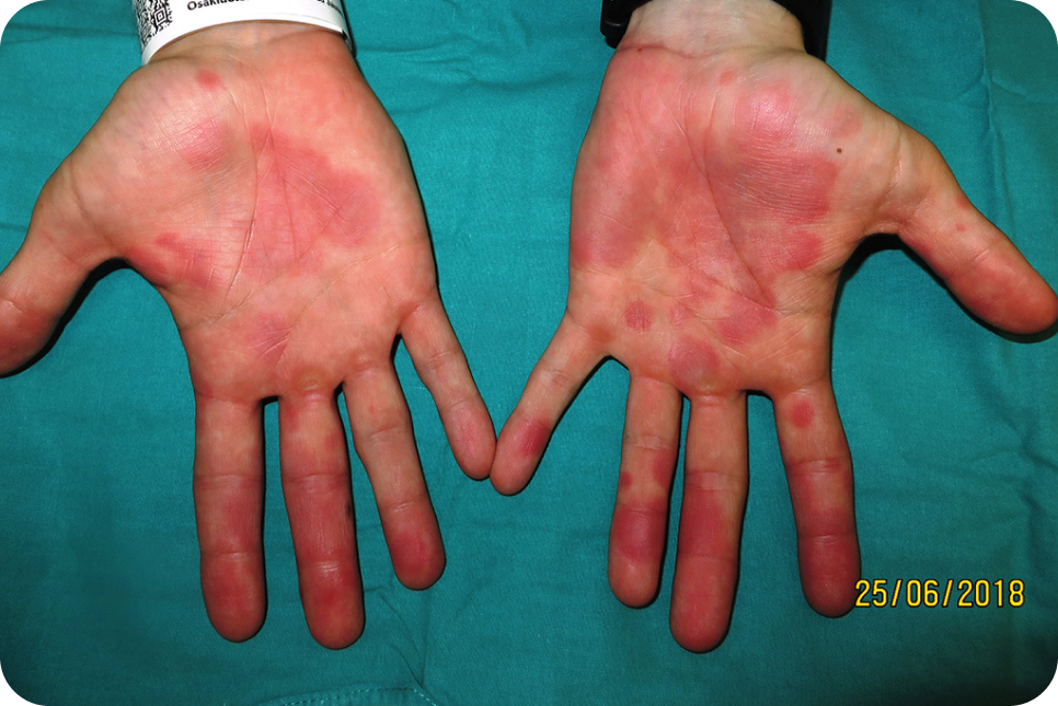 urticaria2-2_2 urticaria2-2_2