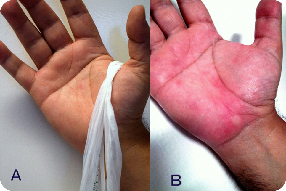 urticaria2-2_3 urticaria2-2_3