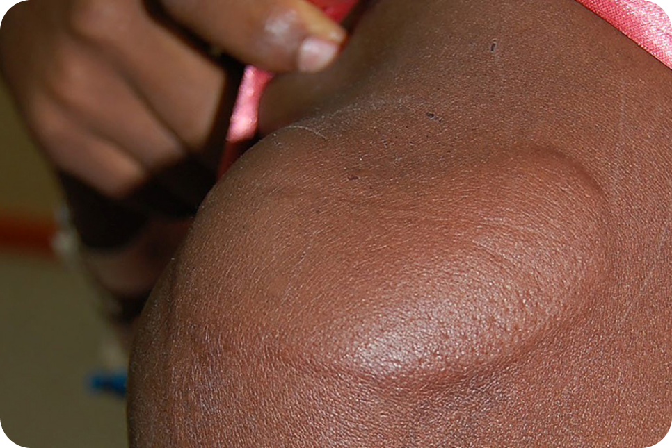 urticaria2-2_4 urticaria2-2_4