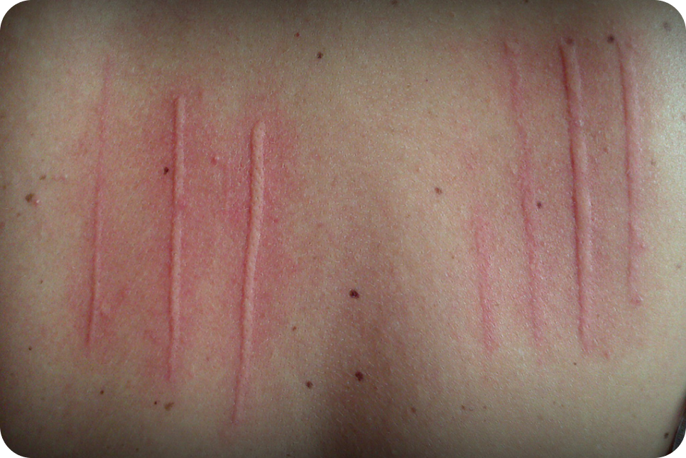 urticaria2_1 urticaria2_1