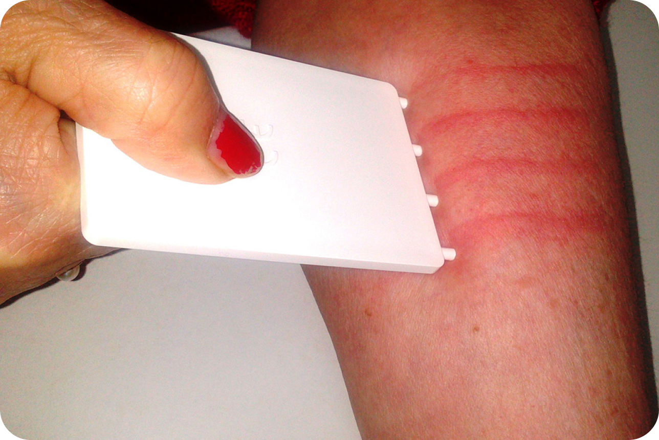urticaria2_1img4 urticaria2_1img4