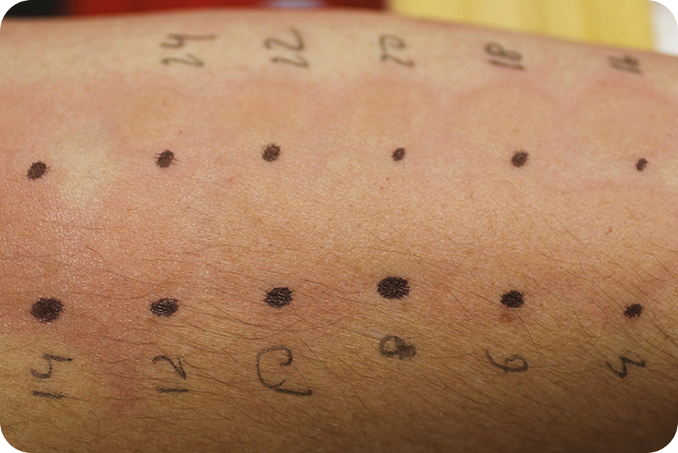 urticaria2_3 urticaria2_3