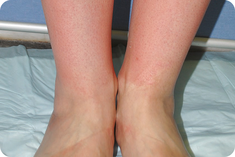 urticaria2_4 urticaria2_4