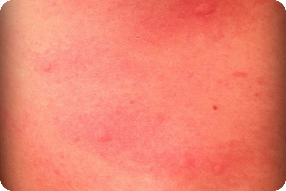 urticaria2_5 urticaria2_5