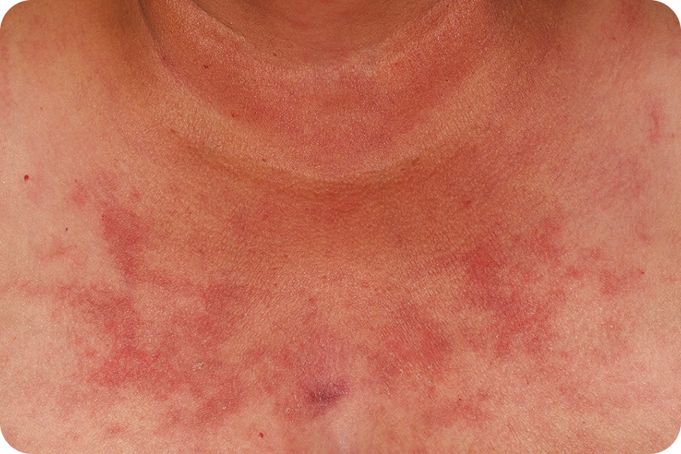urticaria5_1 urticaria5_1
