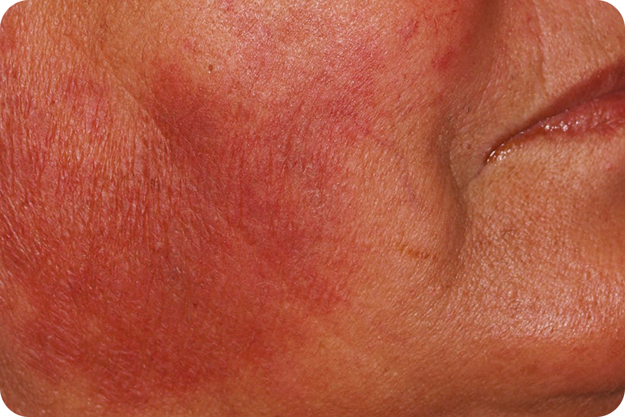 urticaria5_2 urticaria5_2