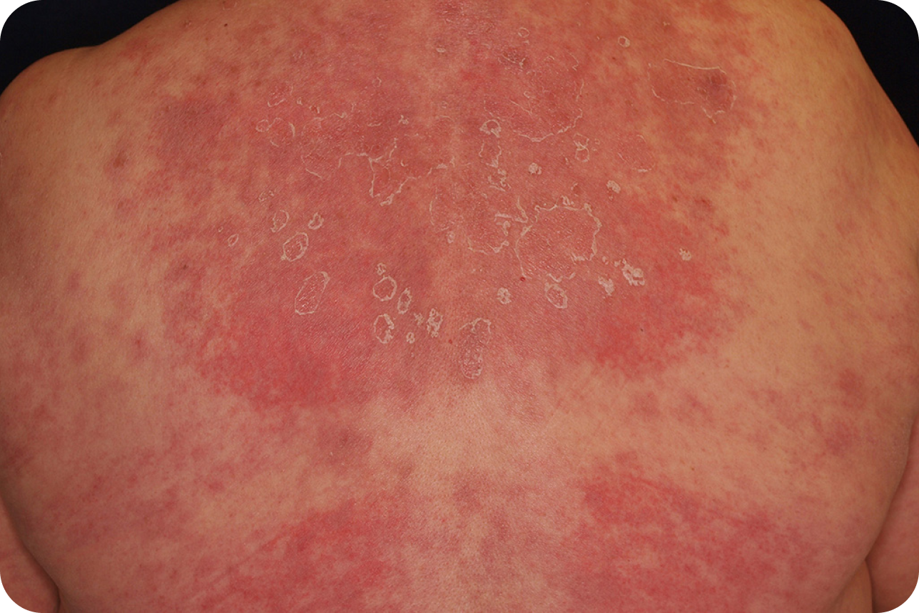 urticaria5_3 urticaria5_3