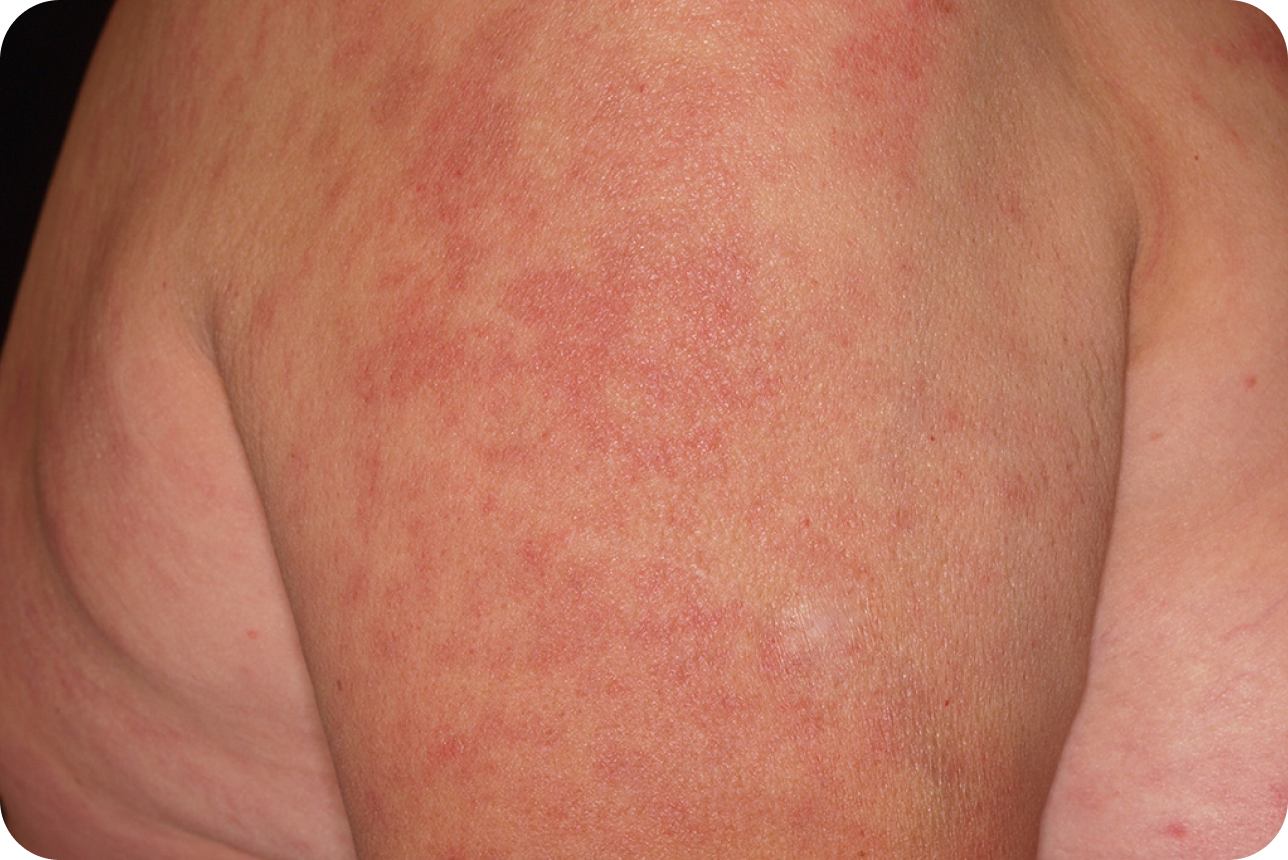 urticaria5_4 urticaria5_4