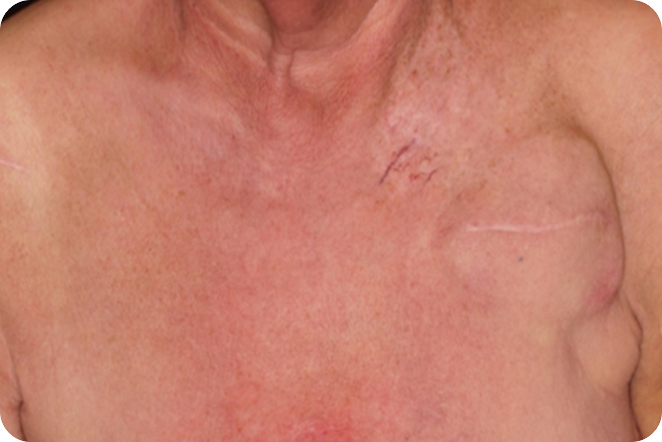 urticaria6_2 urticaria6_2