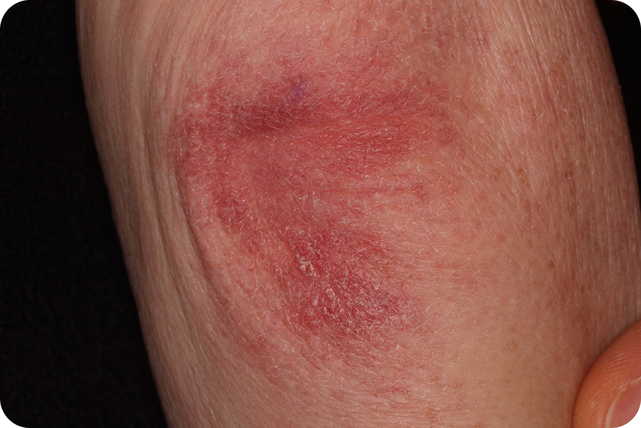 urticaria6_4 urticaria6_4