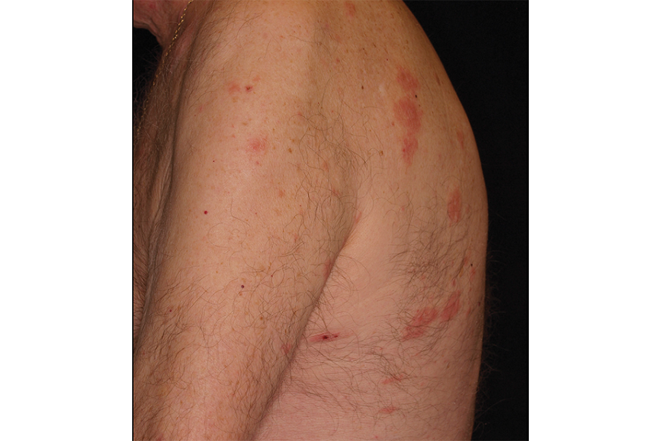 urticaria7_1 urticaria7_1