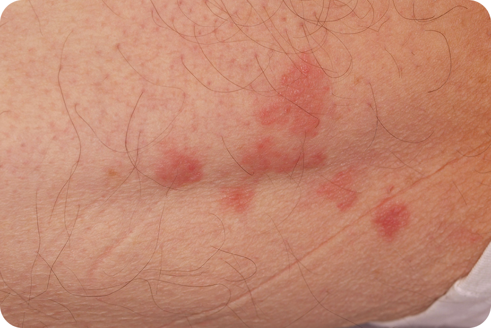 urticaria7_2 urticaria7_2