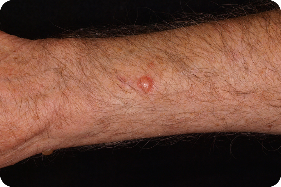 urticaria7_3 urticaria7_3