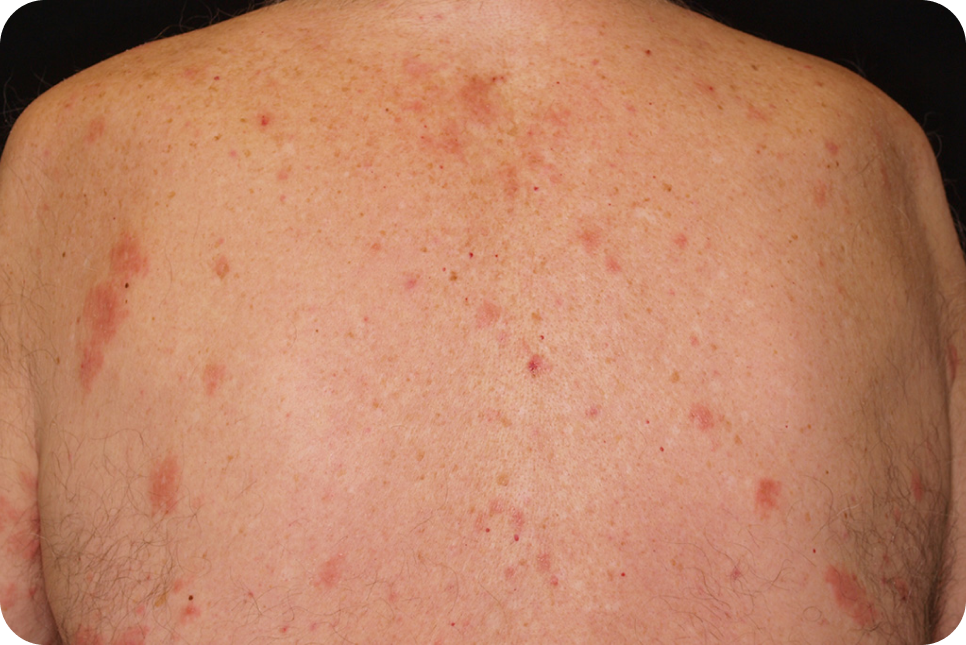 urticaria7_4 urticaria7_4