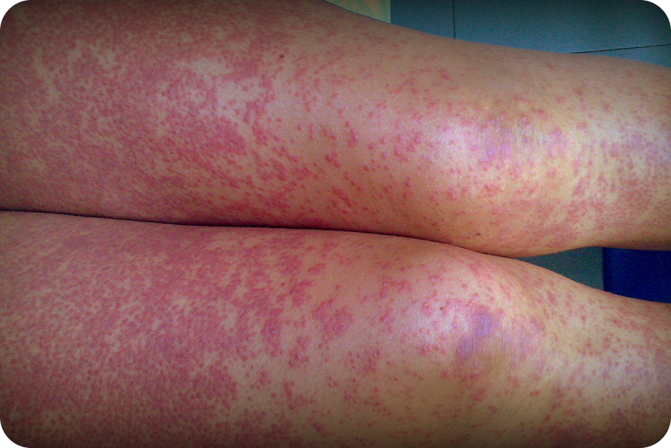 urticaria9_3 urticaria9_3