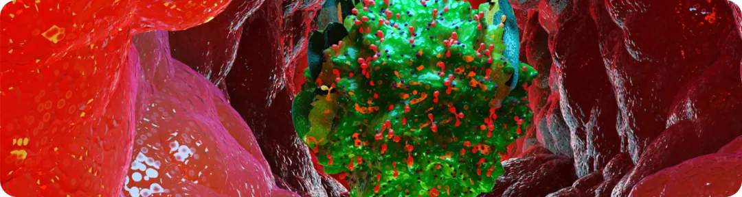 Sobre mastocitosis sistémica avanzada