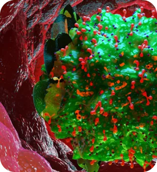 Sobre-mastocitosis-sistemica-avanzada-mobile