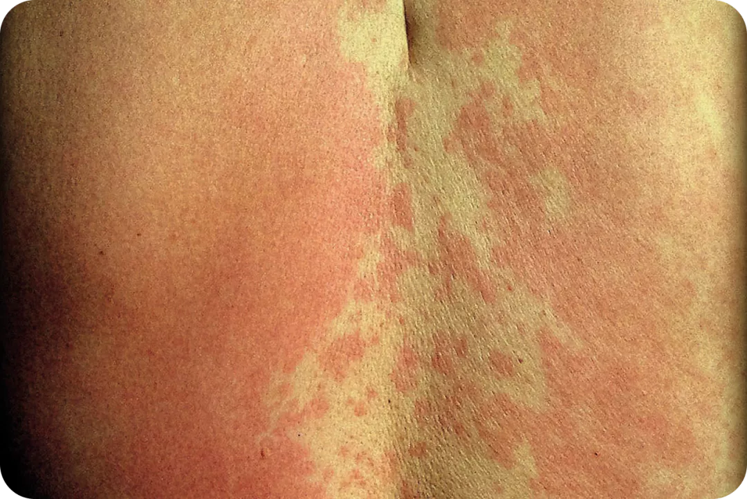 urticaria1-img1