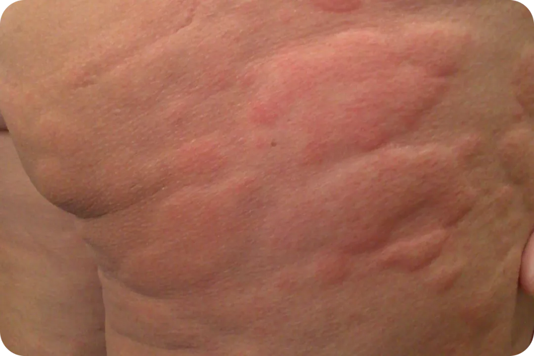 urticaria1-img3