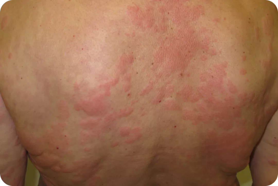 urticaria1-img4