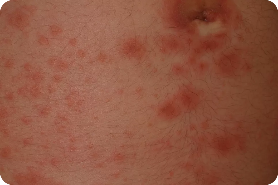 urticaria19_1
