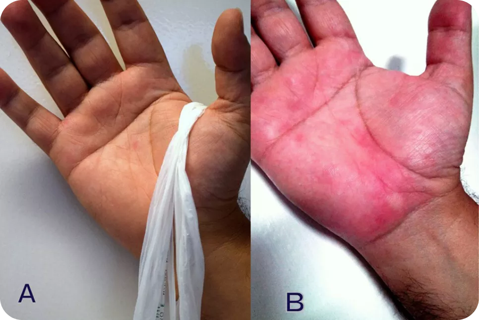 urticaria2_2