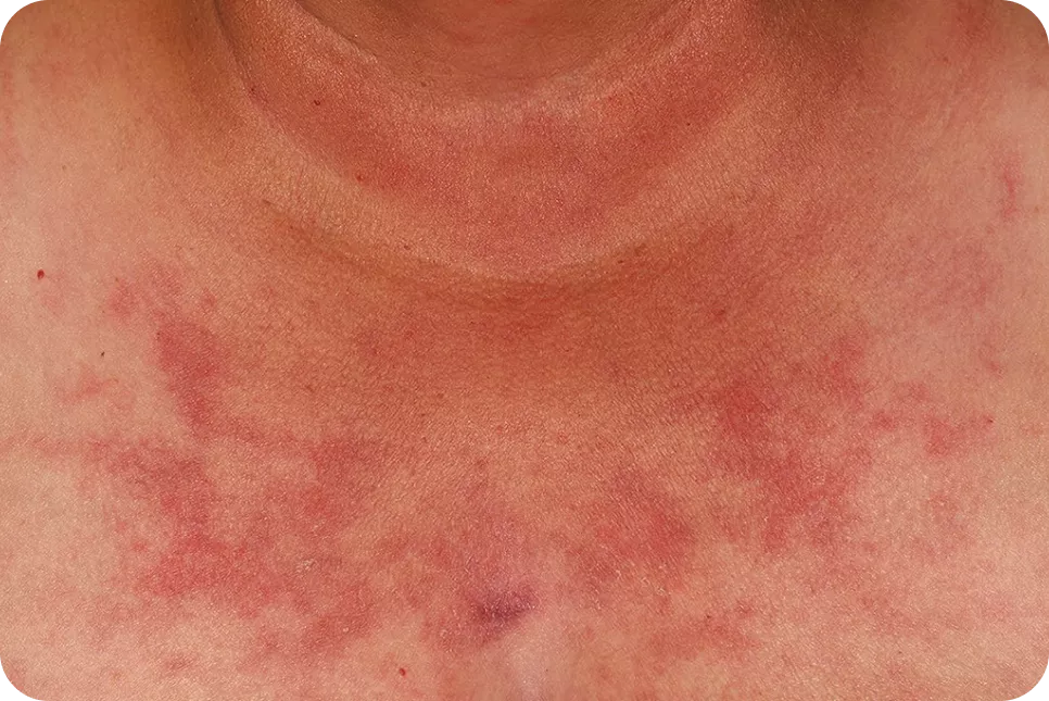 urticaria5_1