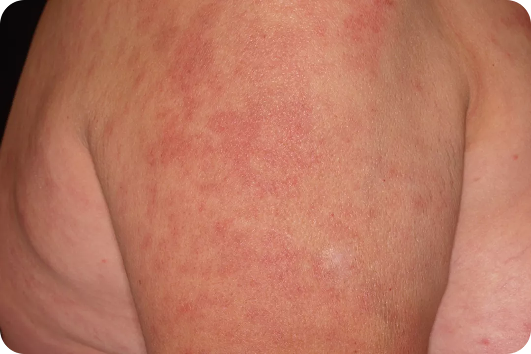 urticaria5_4